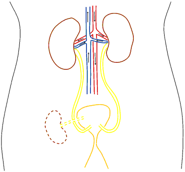 transplanted kidney